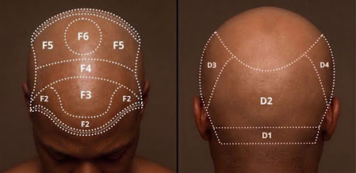 hair transplant